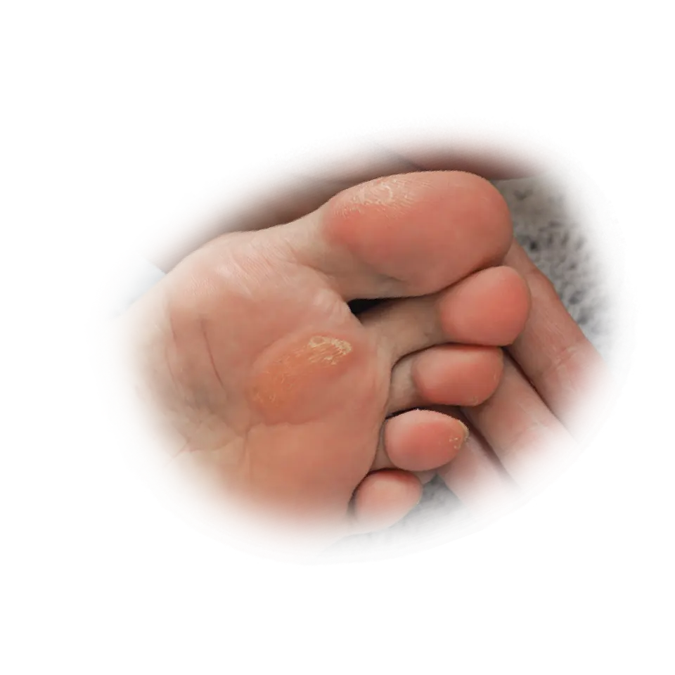 Cure-Aid® Callus Plasters - Pharmaplast