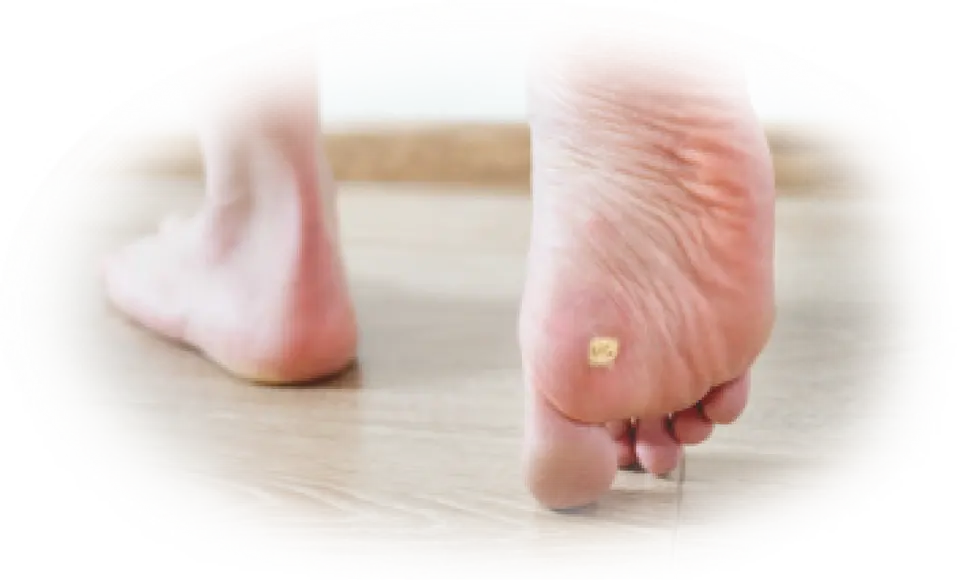 Pharmaplast Cure-aid® Wart Removal Plaster