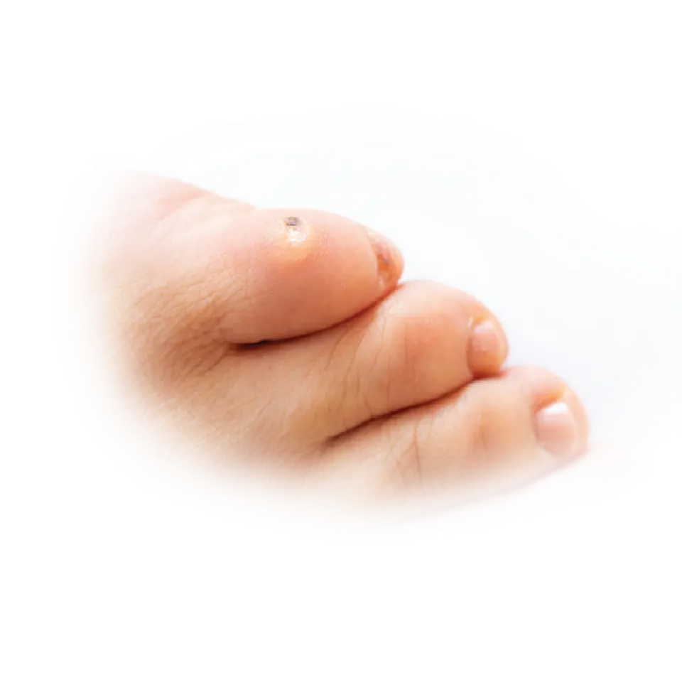 Pharmaplast Cure-aid® Corn Plasters